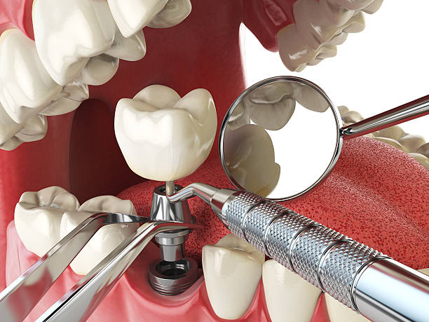 Best Urgent Care for Lost Fillings or Crowns in Rossville, IN